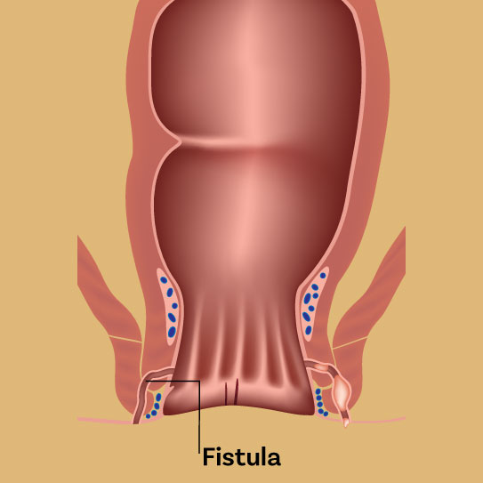 know-more-about-Anal Fistula-treatment-in-Faridabad