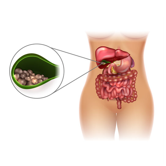 know-more-about-Gallstones-treatment-in-Lucknow