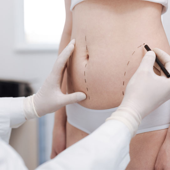know-more-about-Liposuction-treatment-in-Meerut