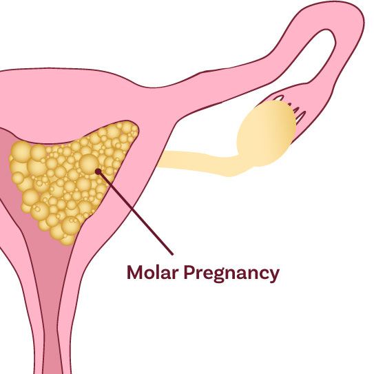 know-more-about-Molar Pregnancy-treatment-in-Gurgaon