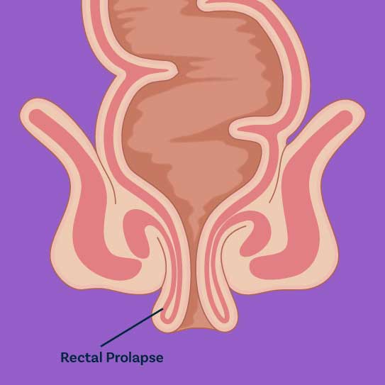 know-more-about-Rectal Prolapse-treatment-in-Coimbatore