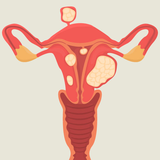 know-more-about-Uterine Fibroids-treatment-in-Bangalore