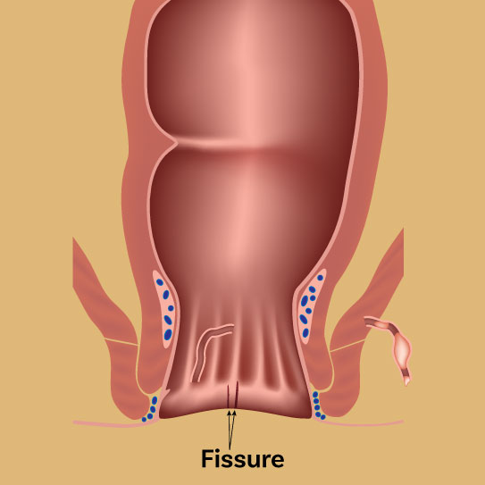 know-more-about-Anal Fissure-treatment-in-Gwalior