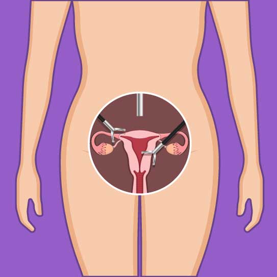 know-more-about-Hysterectomy-treatment-in-Vijayawada
