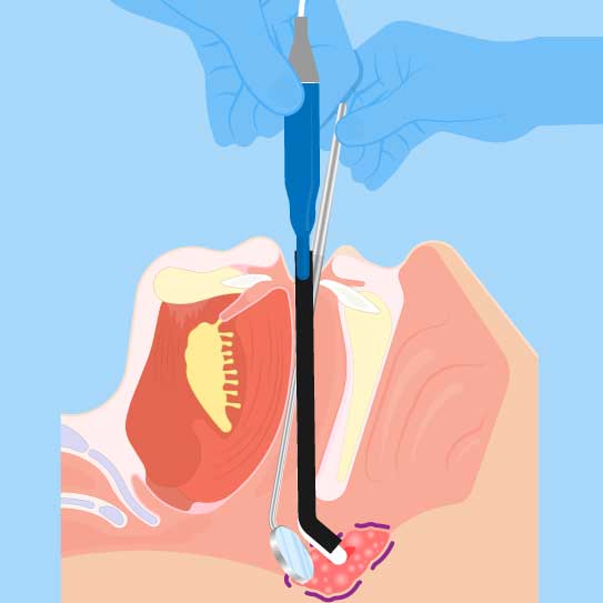 complications-adenoid-removal