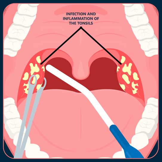 Best Tonsil Removal Tonsillectomy Surgery And Treatment In Shimla At