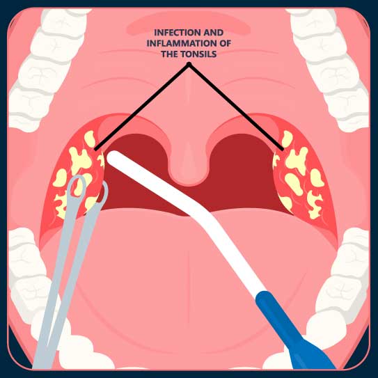 Tonsillectomy And Tonsillitis Explained Via 3d Medica - vrogue.co