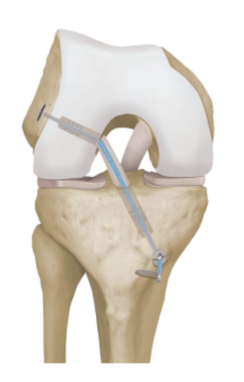 Internal Brace Technology