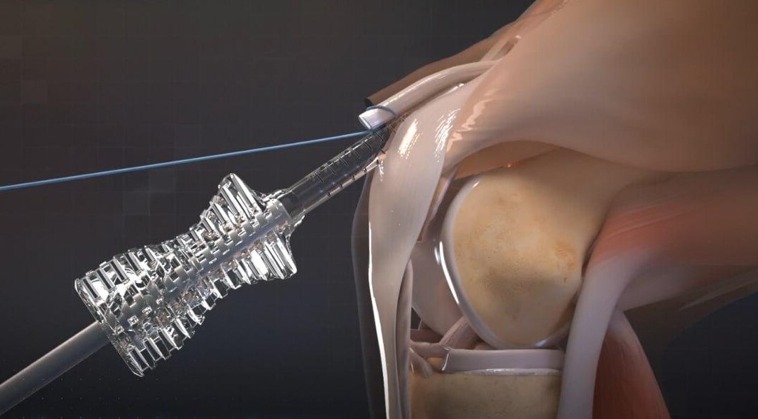 QuadPro ACL Reconstruction