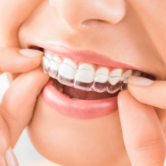 know-more-about-Teeth Aligners-treatment-in-Gurgaon