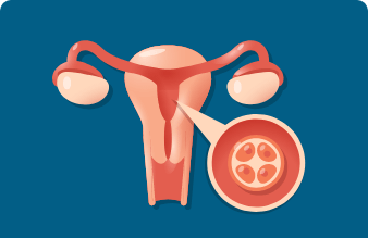 Vaginal Cyst