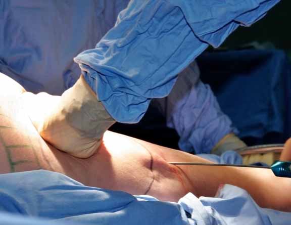 Doctor-performing-Liposuction-surgery-in-Vijayawada